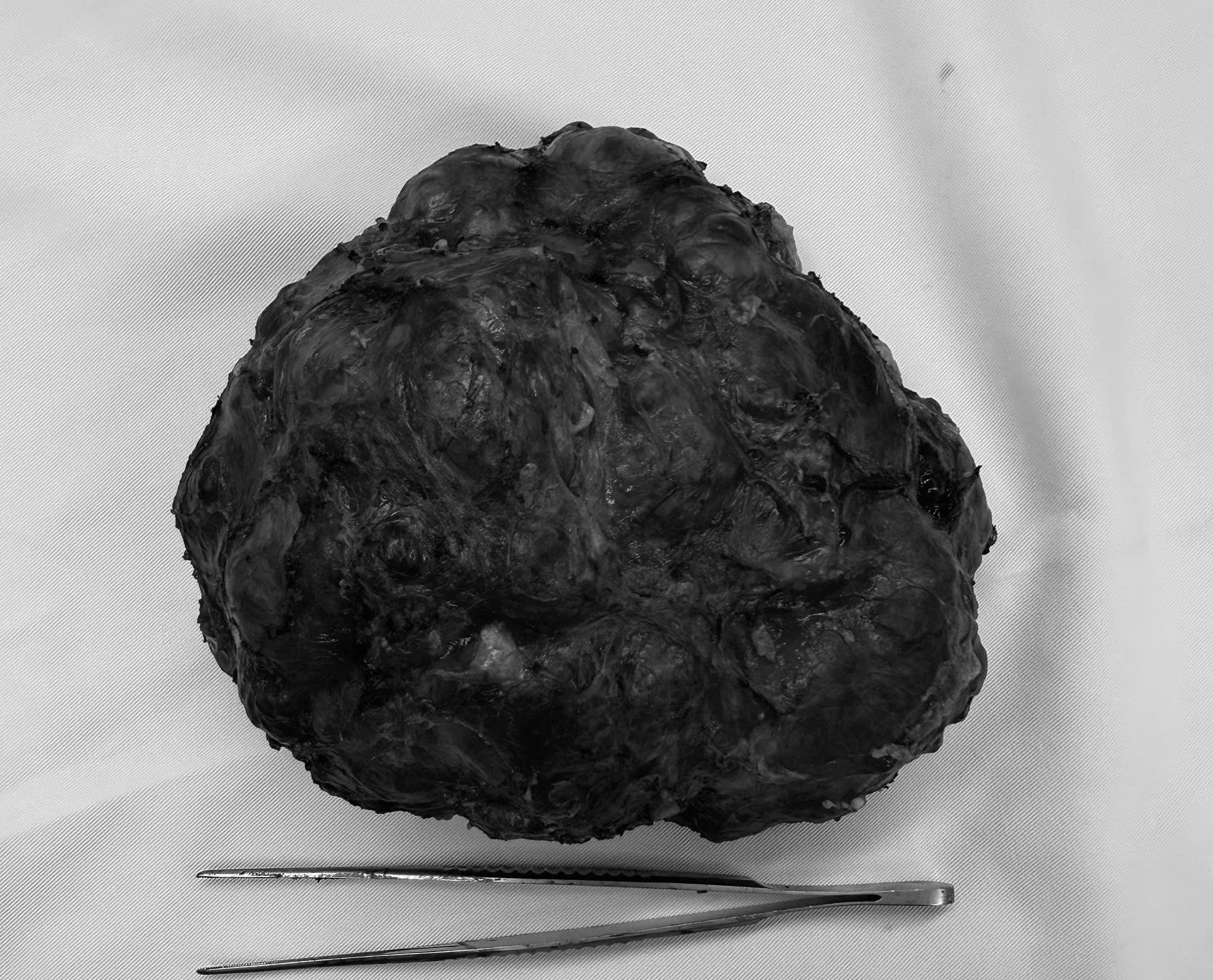 Từ Đức về Việt Nam mổ u vú hiếm gặp lên đến 18cm, cô gái trẻ tìm lại sự tự tin- Ảnh 2.