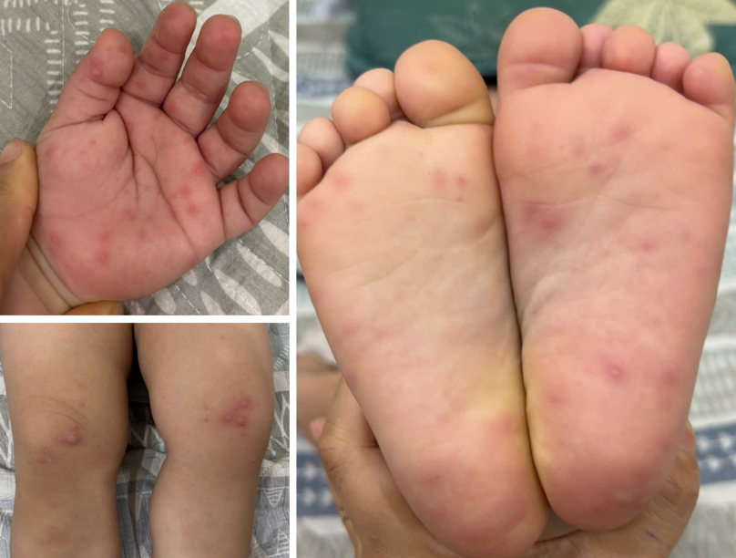 Các cấp độ bệnh tay chân miệng và dấu hiệu cảnh báo- Ảnh 3.