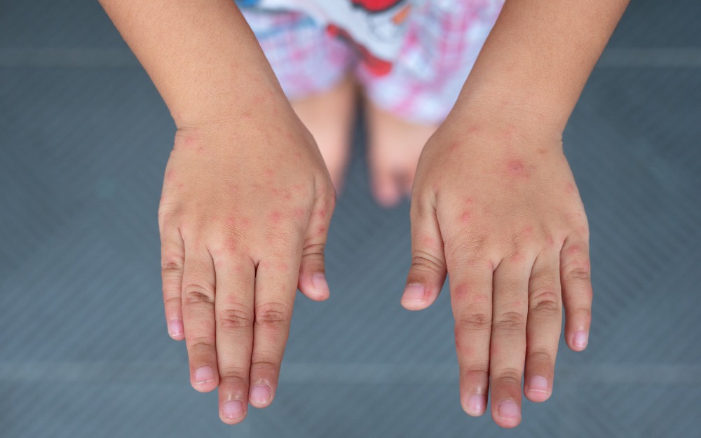 Vì sao bệnh tay chân miệng tăng mạnh ở trẻ mầm non vào đầu tuần?- Ảnh 3.