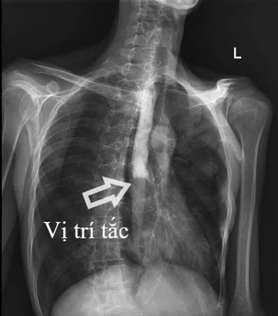 Cứu sống người đàn ông bị thủng đường tiêu hóa nhiều lần ở Quảng Ninh- Ảnh 2. Cứu sống người đàn ông bị thủng đường tiêu hóa nhiều lần ở Quảng Ninh- Ảnh 2.