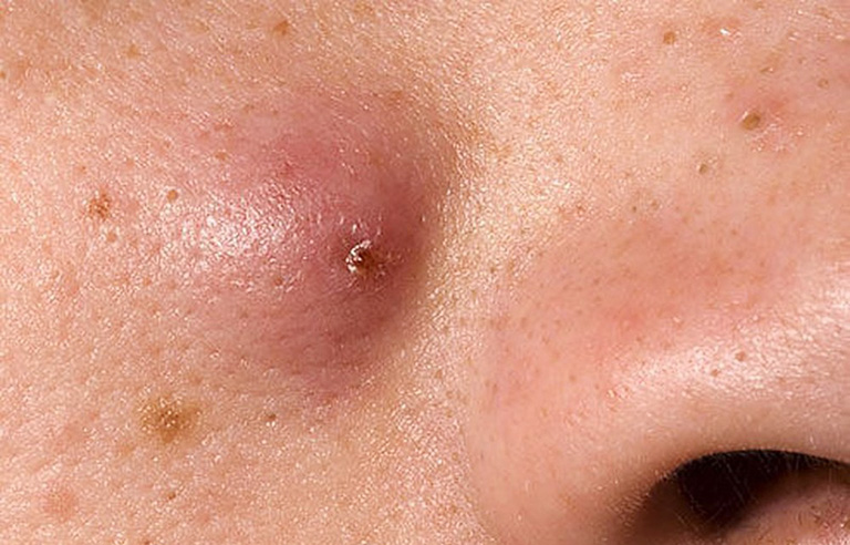 Có nên nặn mụn nhọt ở mặt không? những sai lầm dễ gây biến chứng- Ảnh 1.