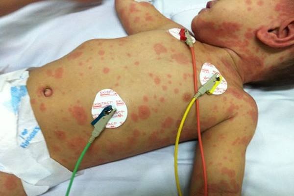 Trẻ em là đối tượng dễ mắc bệnh viêm não mô cầu