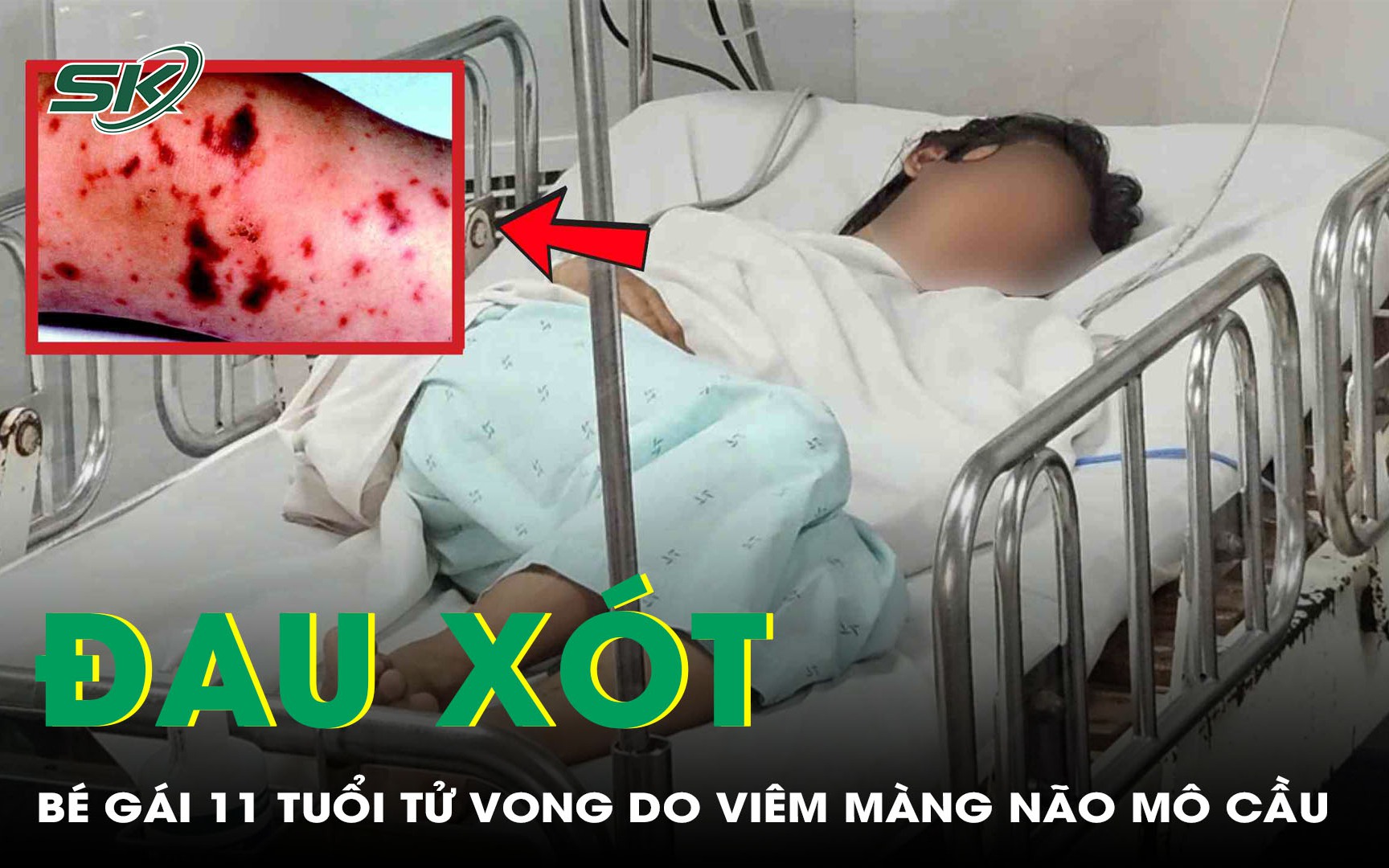 Đau xót: Bé gái 11 tuổi tử vong do viêm màng não mô cầu thể tối cấp