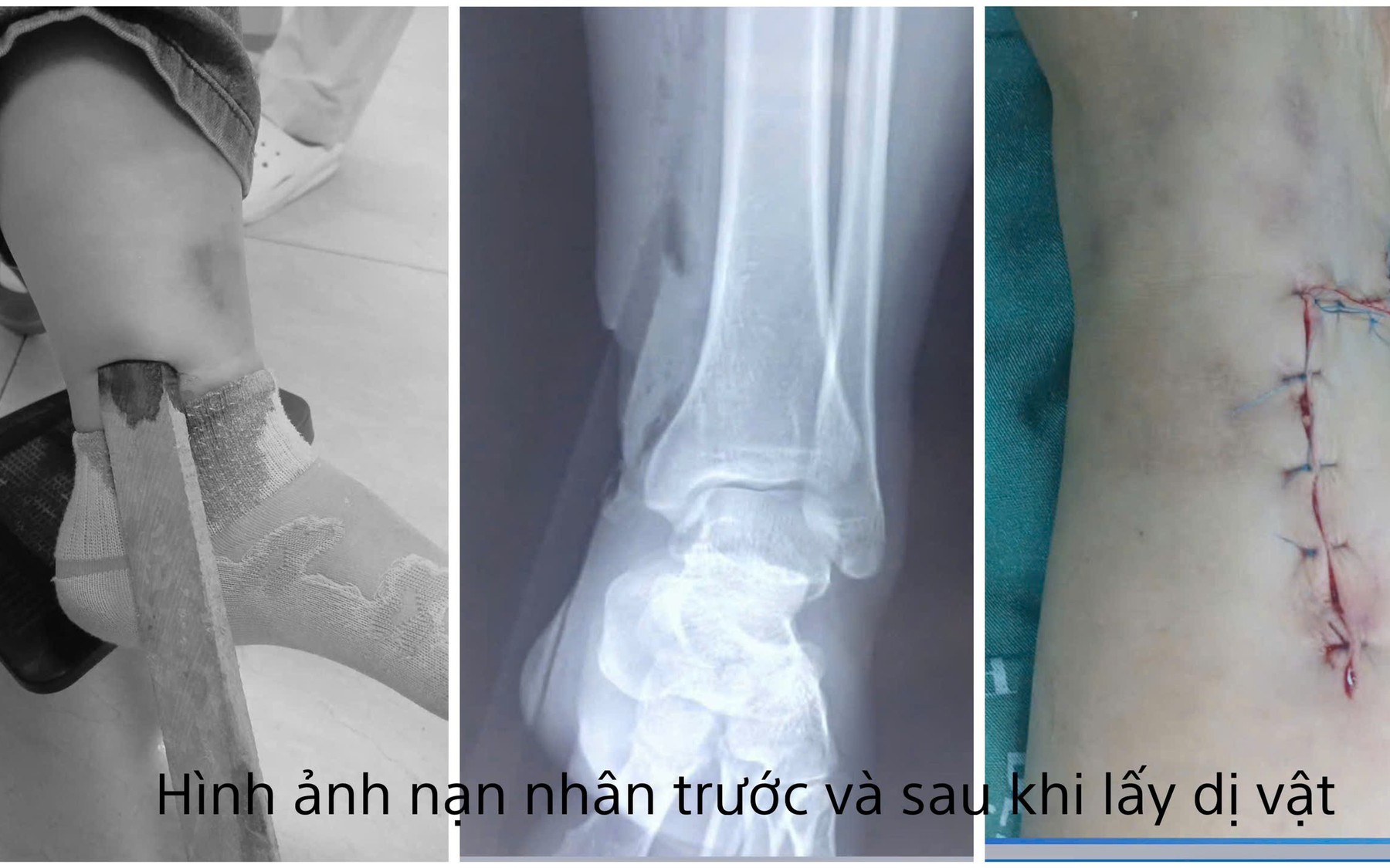 Cụ bà cao tuổi thủng trực tràng vì nuốt hạt nhót- Ảnh 3.