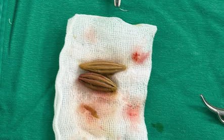 Nữ bệnh nhân ngộ độc thuốc, viêm phổi do vi khuẩn đa kháng được cứu sống tại TTYT miền núi- Ảnh 3.