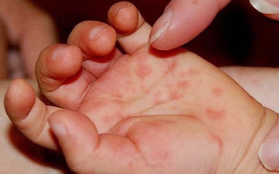 benh tay chan mieng gia tang 1 17458047490681205862246 0 0 571 914 crop 17751414561031193434297