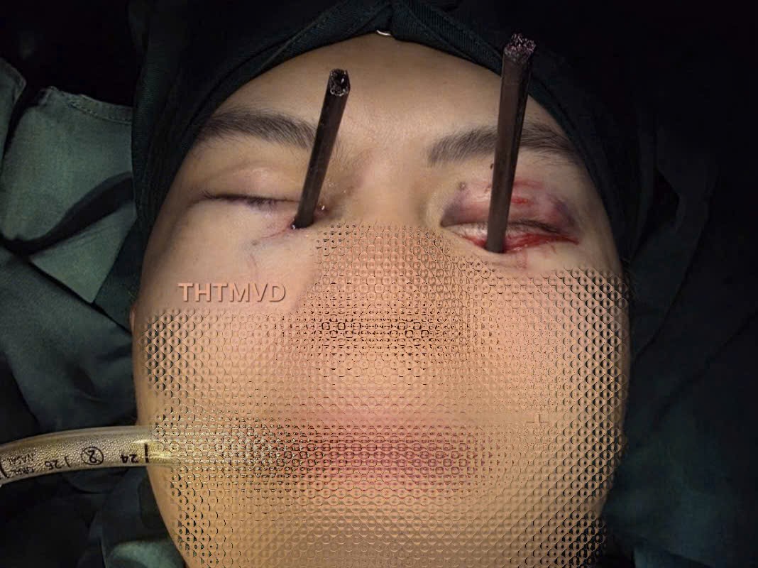 Chưa từng có trong y văn: Người bệnh đến viện cấp cứu với 2 chiếc đũa đâm sâu vào 2 mắt- Ảnh 2.