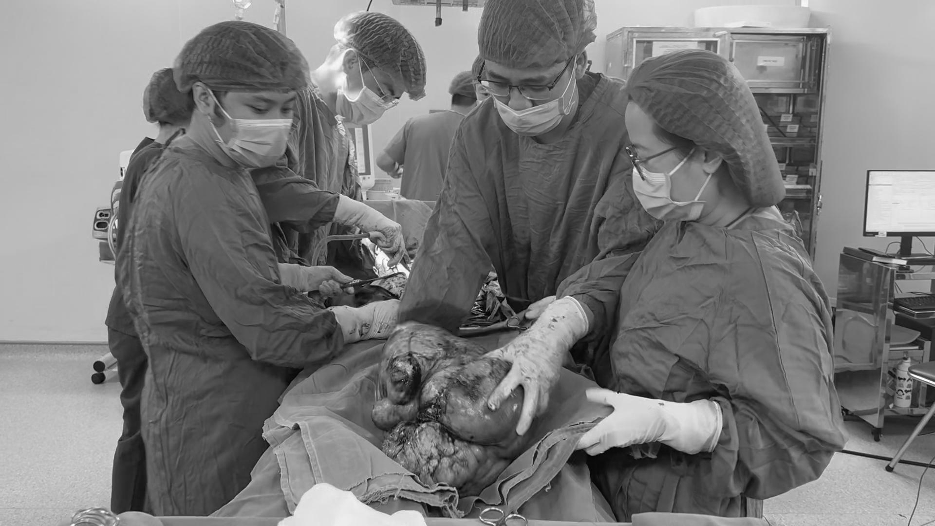 Người phụ nữ chịu đau âm ỉ vùng bụng suốt 6 tháng, đến viện, bác sĩ 'lấy ra' khối u sarcoma tử cung gần 9kg- Ảnh 1.