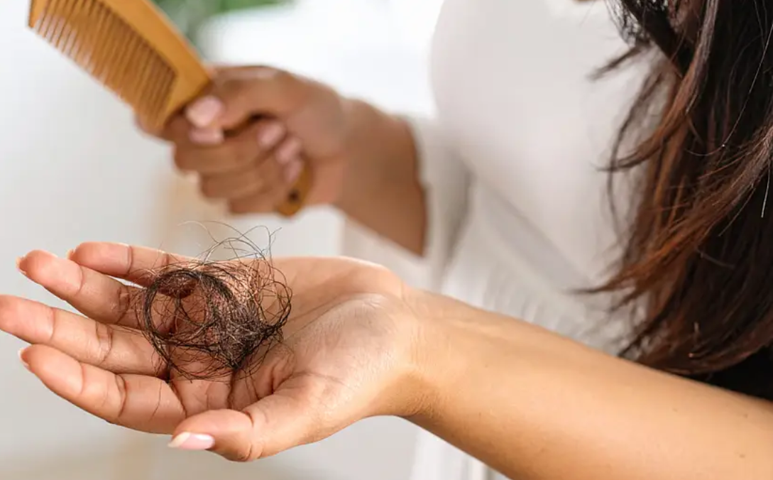 Viêm da tiết bã có gây rụng tóc?- Ảnh 2.