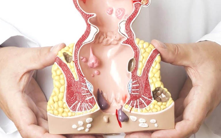 Thói quen xấu khiến bệnh trĩ ngày càng trẻ hóa- Ảnh 2. Bệnh trĩ ngoại có gây biến chứng không?