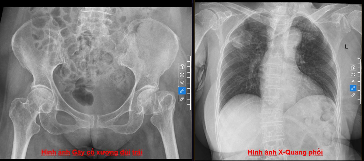 Gãy cổ xương đùi