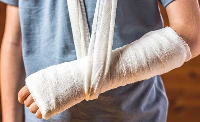 5 dấu hiệu nhận biết gãy xương, những cảnh báo sớm- Ảnh 1.