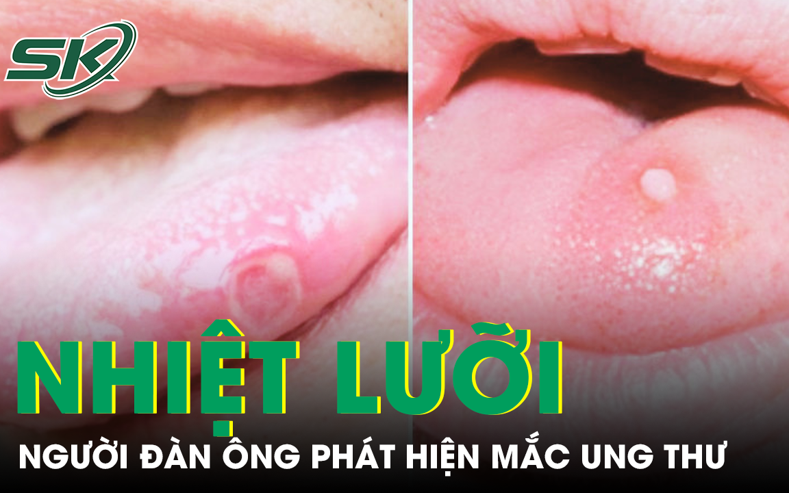6 lưu ý về viêm lưỡi bản đồ ở trẻ em- Ảnh 2.