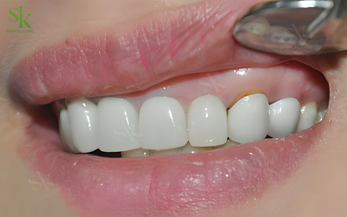 boc rang su 2 17754567378831087479865