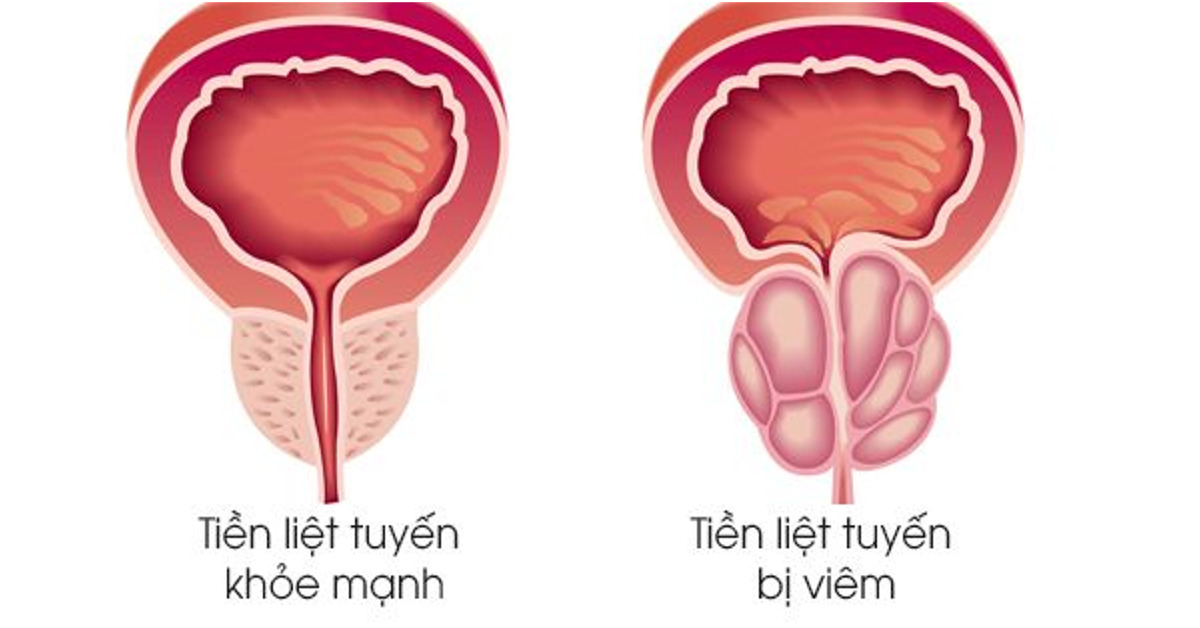 Viêm tuyến tiền liệt có dễ phát hiện không?- Ảnh 1.