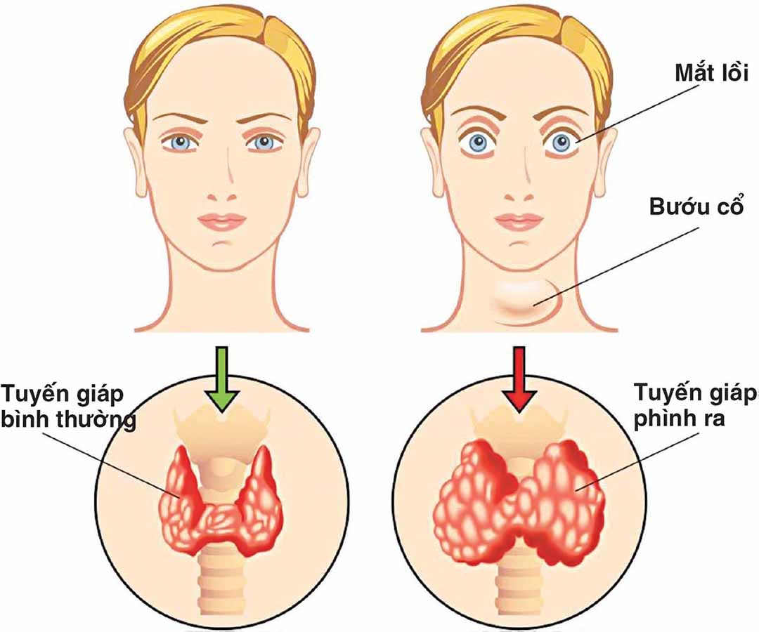 Dùng muối hạt thay muối iod: Thói quen tưởng lành mạnh nhưng chưa chắc phù hợp- Ảnh 2. Dùng muối hạt thay muối iod: Thói quen tưởng lành mạnh nhưng chưa chắc phù hợp- Ảnh 2.