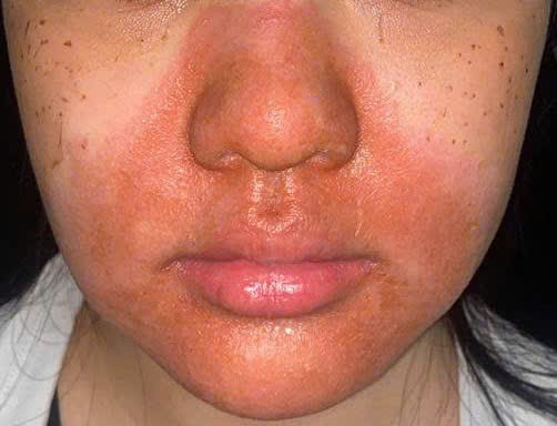 Peel da mặt làm đẹp, cô gái mọc chi chít mụn nước, vỡ chảy dịch- Ảnh 2.