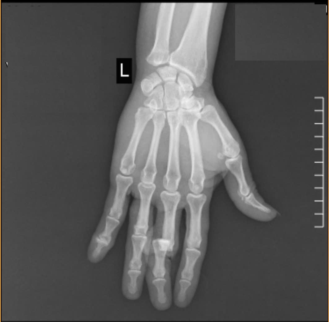 Microsurgery saves severed finger of female construction worker whose ...