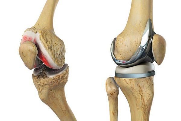 Thay khớp gối nhân tạo là một giải pháp hiệu quả cho những trường hợp tổn thương khớp nặng, giúp cải thiện đáng kể chất lượng cuộc sống.