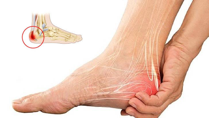 Biểu hiện điển hình khi mắc gai gót chân, đừng chủ quan với những cơn đau ở bàn chân- Ảnh 1.