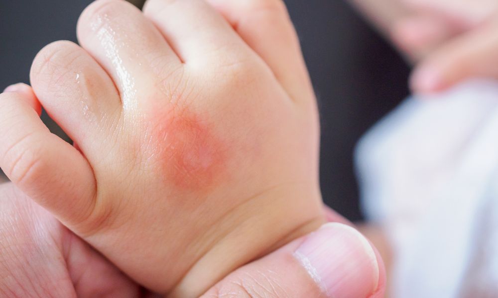 Cách sử dụng vỏ chuối để trị 3 tình trạng ngoài da thường gặp- Ảnh 2. Cách sử dụng vỏ chuối để trị 3 tình trạng ngoài da thường gặp- Ảnh 2.