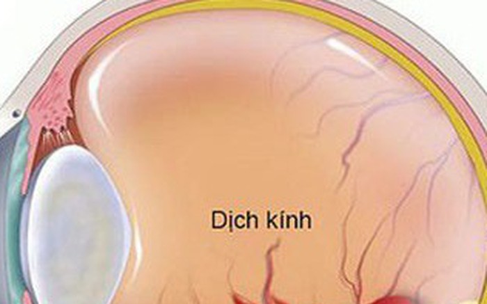 Nguyên nhân gây cộm mắt và cách khắc phục- Ảnh 2.