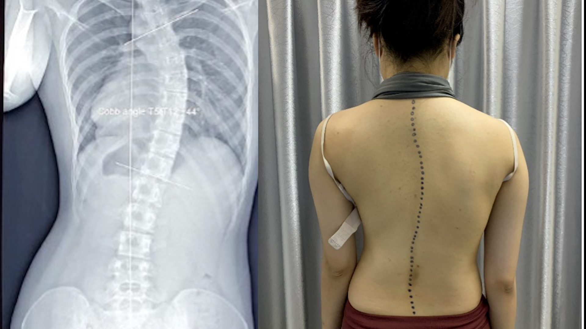 Vẹo cột sống ở trẻ gây hệ lụy gì?- Ảnh 1. Vẹo cột sống ở trẻ gây hệ lụy gì?- Ảnh 1.