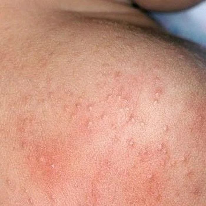 Mùa hè nhiều rôm sảy cần xử trí ra sao?- Ảnh 1. Mùa hè nhiều rôm sảy cần xử trí ra sao?- Ảnh 1.