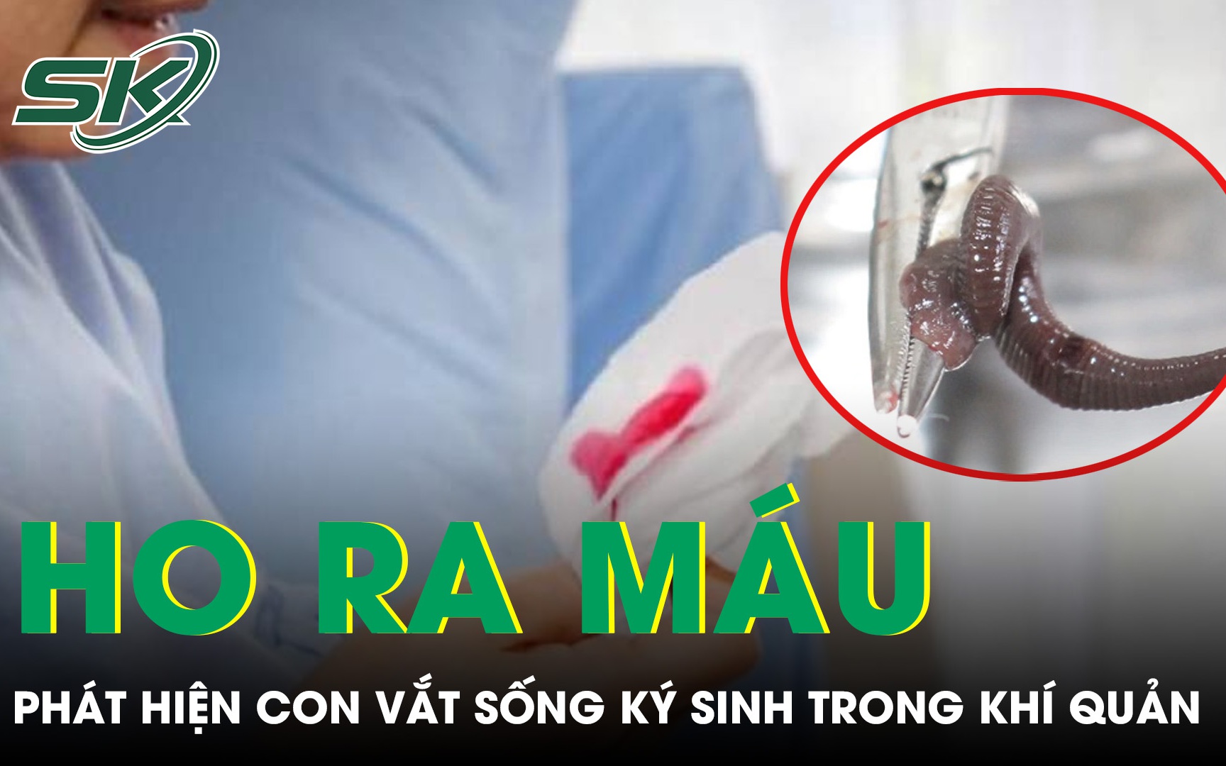 Ho có thể là dấu hiệu của nhiều bệnh lý, cách giảm ho hiệu quả- Ảnh 3. Ho ra máu suốt một tháng, bàng hoàng phát hiện con vắt sống ký sinh trong khí quản