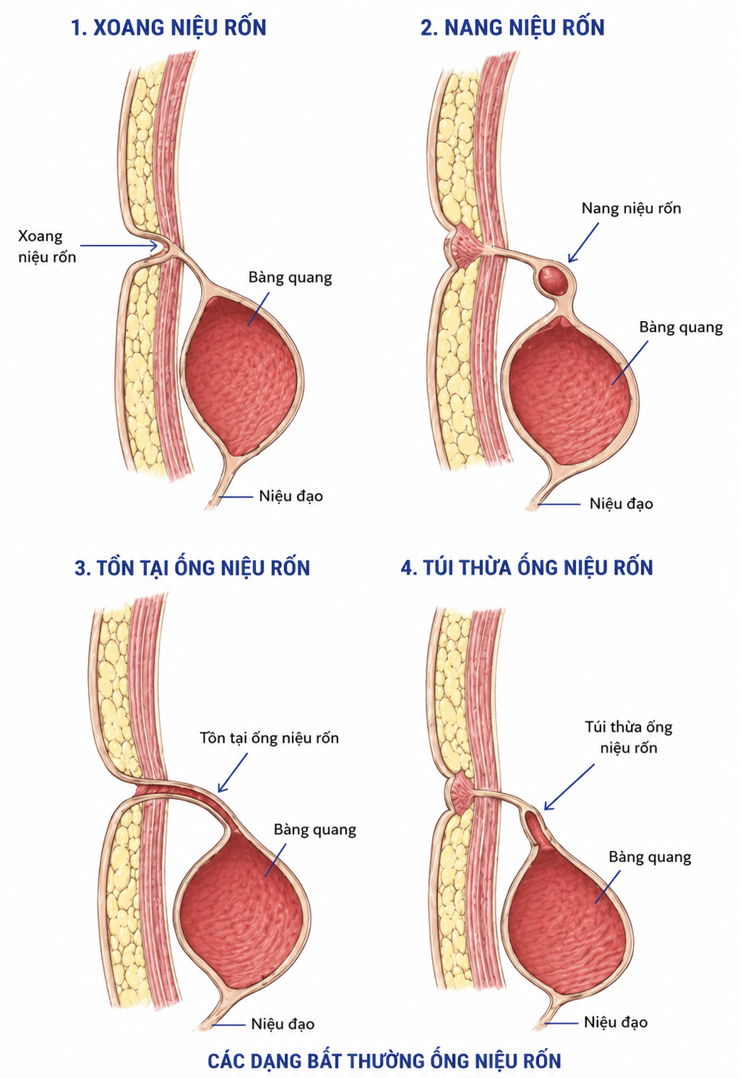 Bệnh viện Quân y 354: Phẫu thuật thành công ca xoang niệu rốn hiếm gặp ở người trưởng thành- Ảnh 2. Bệnh viện Quân y 354: Phẫu thuật thành công ca xoang niệu rốn hiếm gặp ở người trưởng thành- Ảnh 2.
