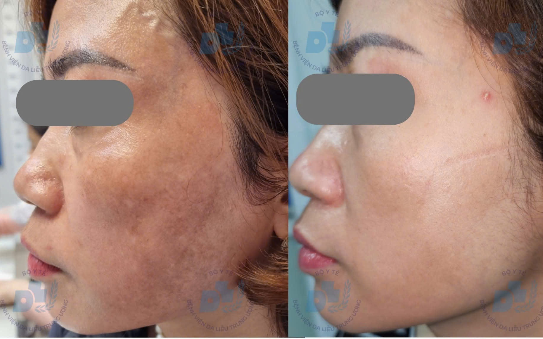 Giới trẻ tiêm botox, filler sớm để phòng lão hóa: Chuyên gia nói gì?- Ảnh 4. Bác sĩ chỉ rõ lý do nhiều người trị nám tốn kém nhưng vẫn tái phát