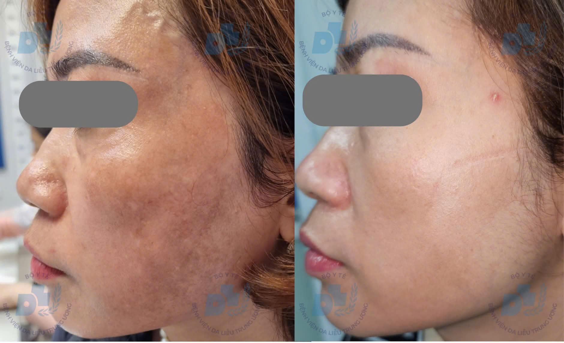 Bác sĩ chỉ rõ lý do nhiều người trị nám tốn kém nhưng vẫn tái phát- Ảnh 2.