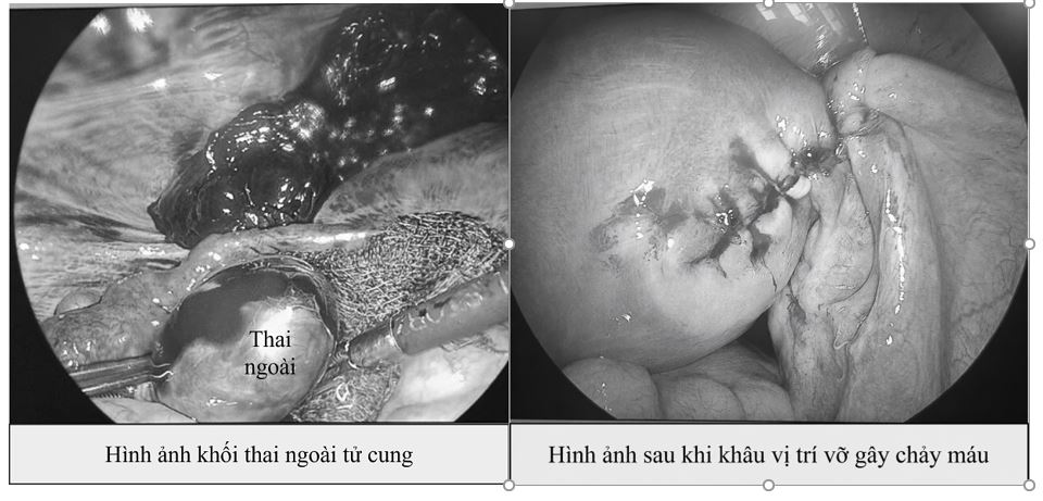 Hiếm gặp: Vừa có thai trong tử cung vừa có thai ngoài tử cung- Ảnh 1.