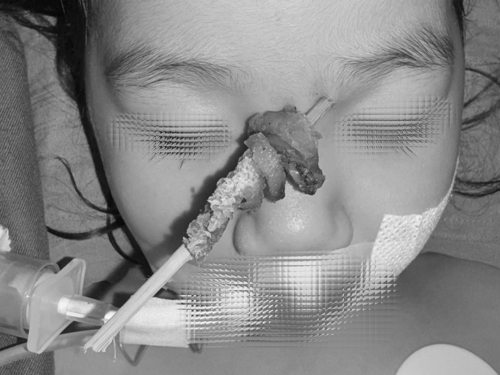 Tai nạn hy hữu: Bé gái 2,5 tuổi bị que xiên thịt đâm sâu, nguy cơ xuyên sọ não- Ảnh 1. Tai nạn hy hữu: Bé gái 2,5 tuổi bị que xiên thịt đâm sâu, nguy cơ xuyên sọ não- Ảnh 1.