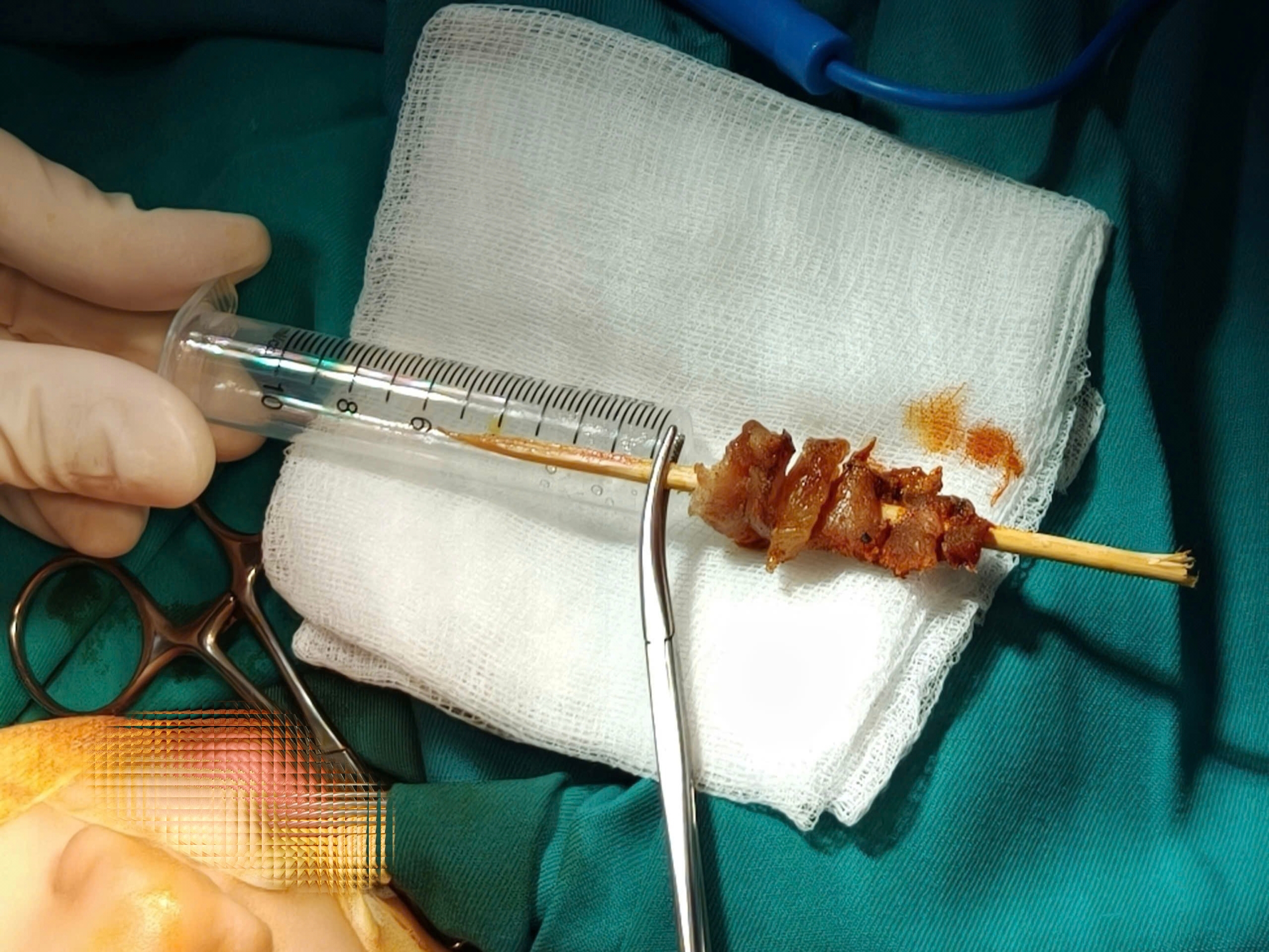 Tai nạn hy hữu: Bé gái 2,5 tuổi bị que xiên thịt đâm sâu, nguy cơ xuyên sọ não- Ảnh 2. Tai nạn hy hữu: Bé gái 2,5 tuổi bị que xiên thịt đâm sâu, nguy cơ xuyên sọ não- Ảnh 2.