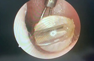 Dị vật tai hay gặp và cách xử trí đúng- Ảnh 3.
