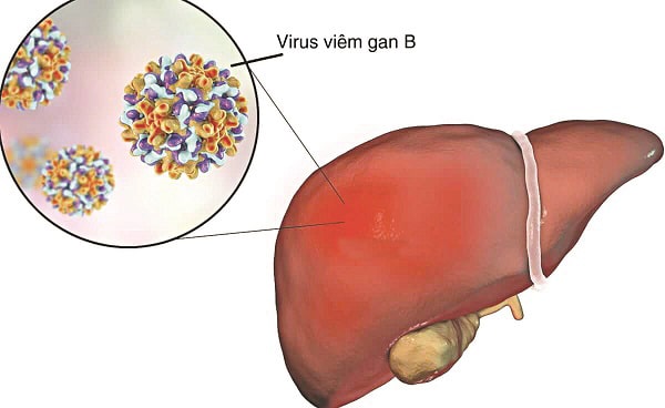 Viêm gan B có lây qua ăn uống, ôm hôn không và cách phòng tránh- Ảnh 1. Viêm gan B là gì? Tổng quan về viêm gan B