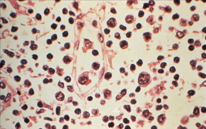Nhiễm virus Hanta từ môi trường có nhiều chuột: cách phát hiện sớm để tránh biến chứng nguy hiểm- Ảnh 2.