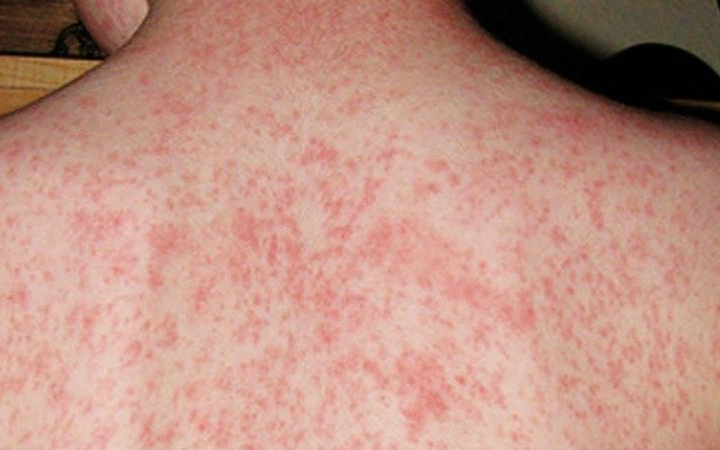 Bệnh sởi đang gia tăng: Những điều cha mẹ cần biết để bảo vệ trẻ - Ảnh 2.