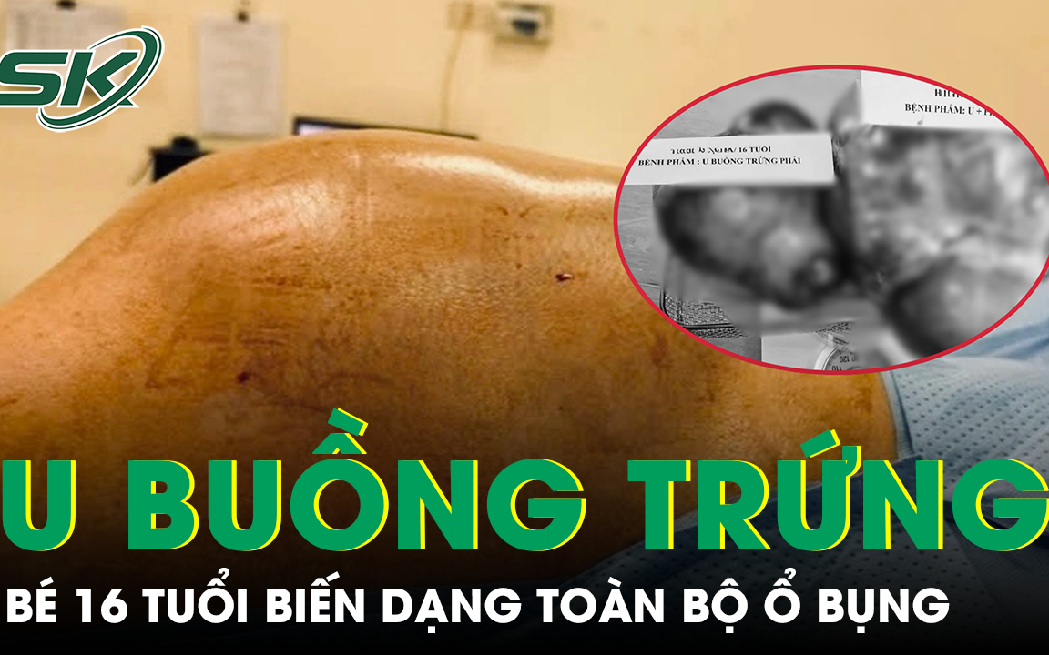 Bé gái bụng to bất thường, cảnh giác với khối u buồng trứng  - Ảnh 2.
