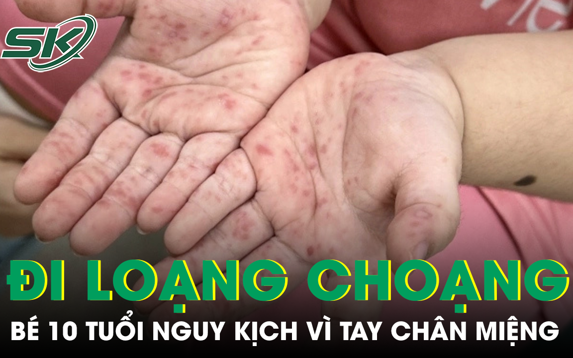 Mỗi tuần có 3.000 ca tay chân miệng, Bộ Y tế khuyến cáo '3 sạch' phòng bệnh- Ảnh 2.