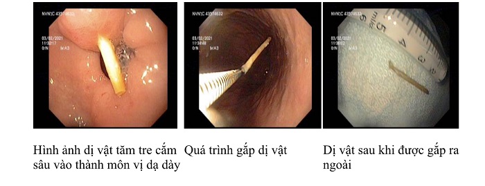 Thói quen ngậm tăm sau ăn hệ lụy khó lường- Ảnh 1. Thói quen ngậm tăm sau ăn hệ lụy khó lường- Ảnh 1.