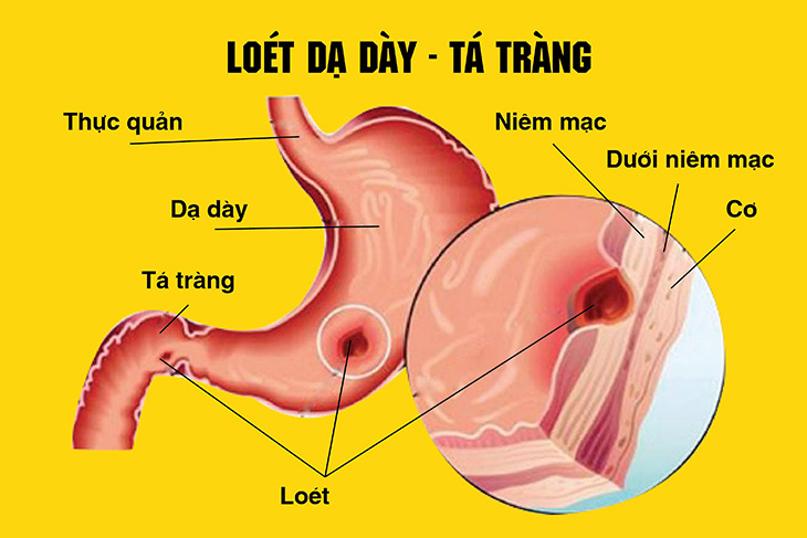 Những nguy cơ khi tự ý dùng meloxicam trị đau xương khớp - Ảnh 1.