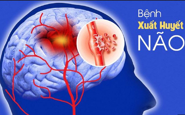 Những yếu tố làm tăng nguy cơ xuất huyết não- Ảnh 2.
