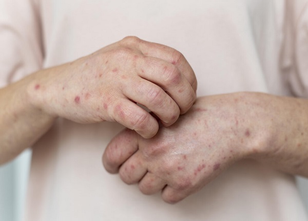 5 dấu hiệu cảnh báo nhiễm HIV nhiều người nhầm với bệnh thông thường - Ảnh 2.