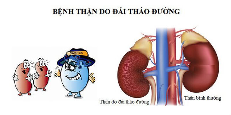Thuốc SGLT2i - bước tiến mới giúp bảo vệ thận cho người bệnh đái tháo đường - Ảnh 2.