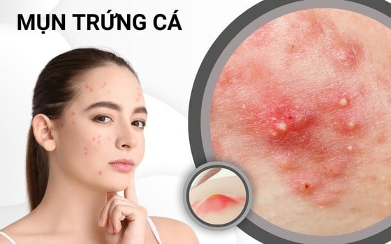 5 cách giảm nguy cơ để lại vết thâm sau mụn trứng cá- Ảnh 2.