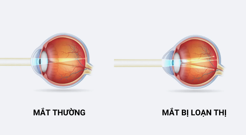 Trẻ bị loạn thị có cần đeo kính không?- Ảnh 1. Trẻ bị loạn thị có cần đeo kính không?- Ảnh 1.