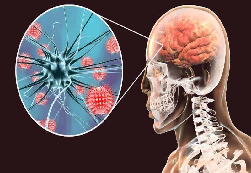 Viêm não tự miễn có nguy cơ tử vong cao nếu chẩn đoán muộn- Ảnh 1. Viêm não tự miễn có nguy cơ tử vong cao nếu chẩn đoán muộn- Ảnh 1.