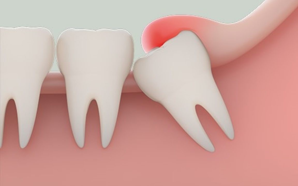 Nguy Cơ Từ Việc Nhổ Răng Tại Nhà: Câu Chuyện Của Bé Trai 7 Tuổi